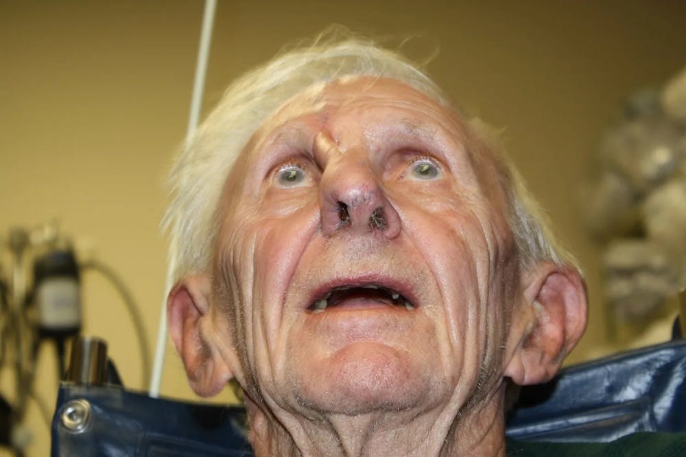 Facial and MOHS Reconstruction Before & After Gallery - Patient 5800768 - Image 10