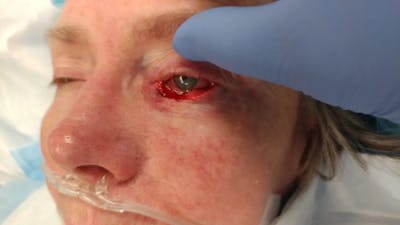 Facial and MOHS Reconstruction Before & After Gallery - Patient 5800769 - Image 2