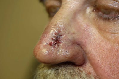 Facial and MOHS Reconstruction Before & After Gallery - Patient 5800770 - Image 2
