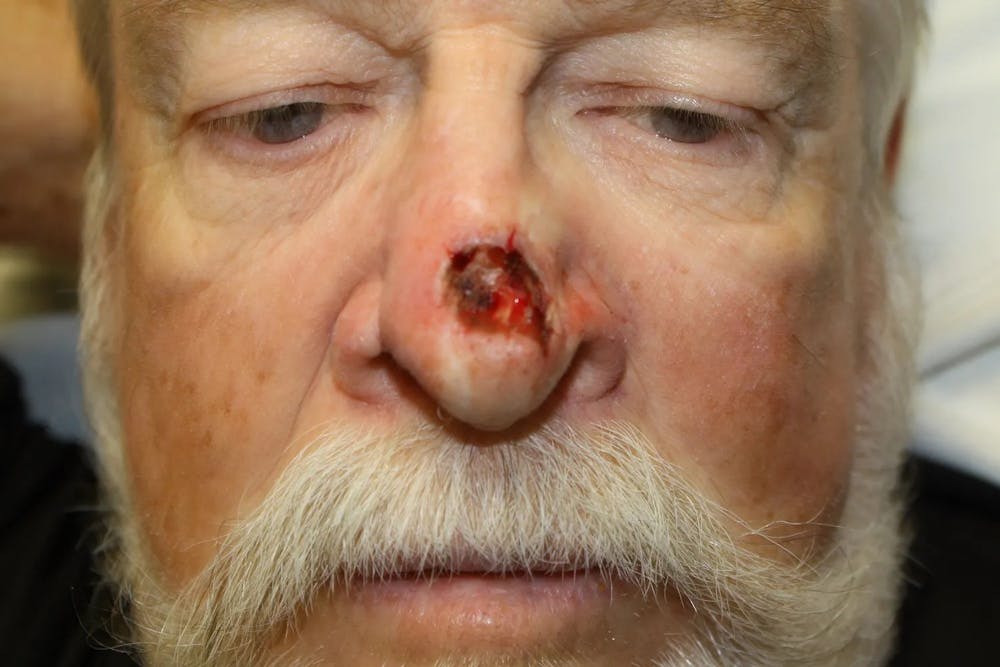 Facial and MOHS Reconstruction Before & After Gallery - Patient 5800804 - Image 2