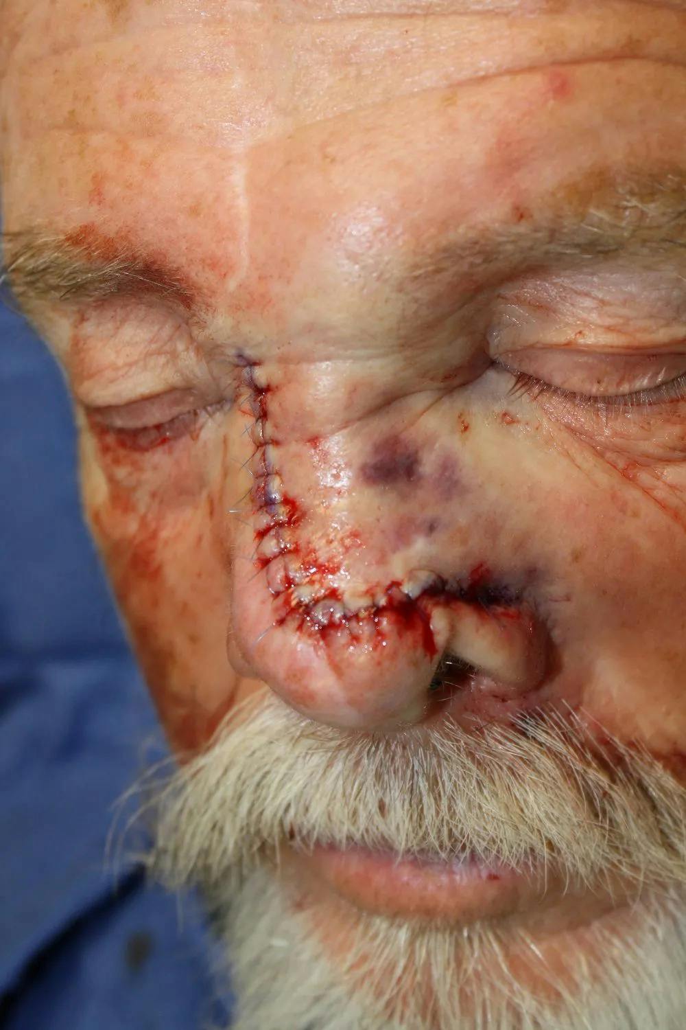 Facial and MOHS Reconstruction Before & After Gallery - Patient 5800804 - Image 3