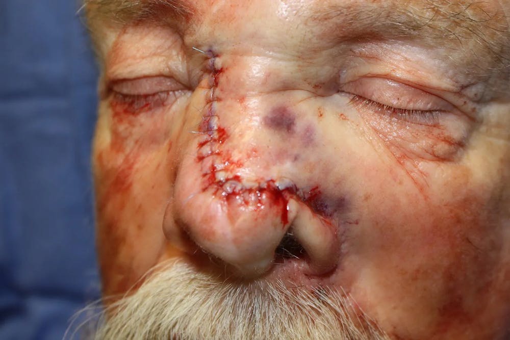 Facial and MOHS Reconstruction Before & After Gallery - Patient 5800804 - Image 4