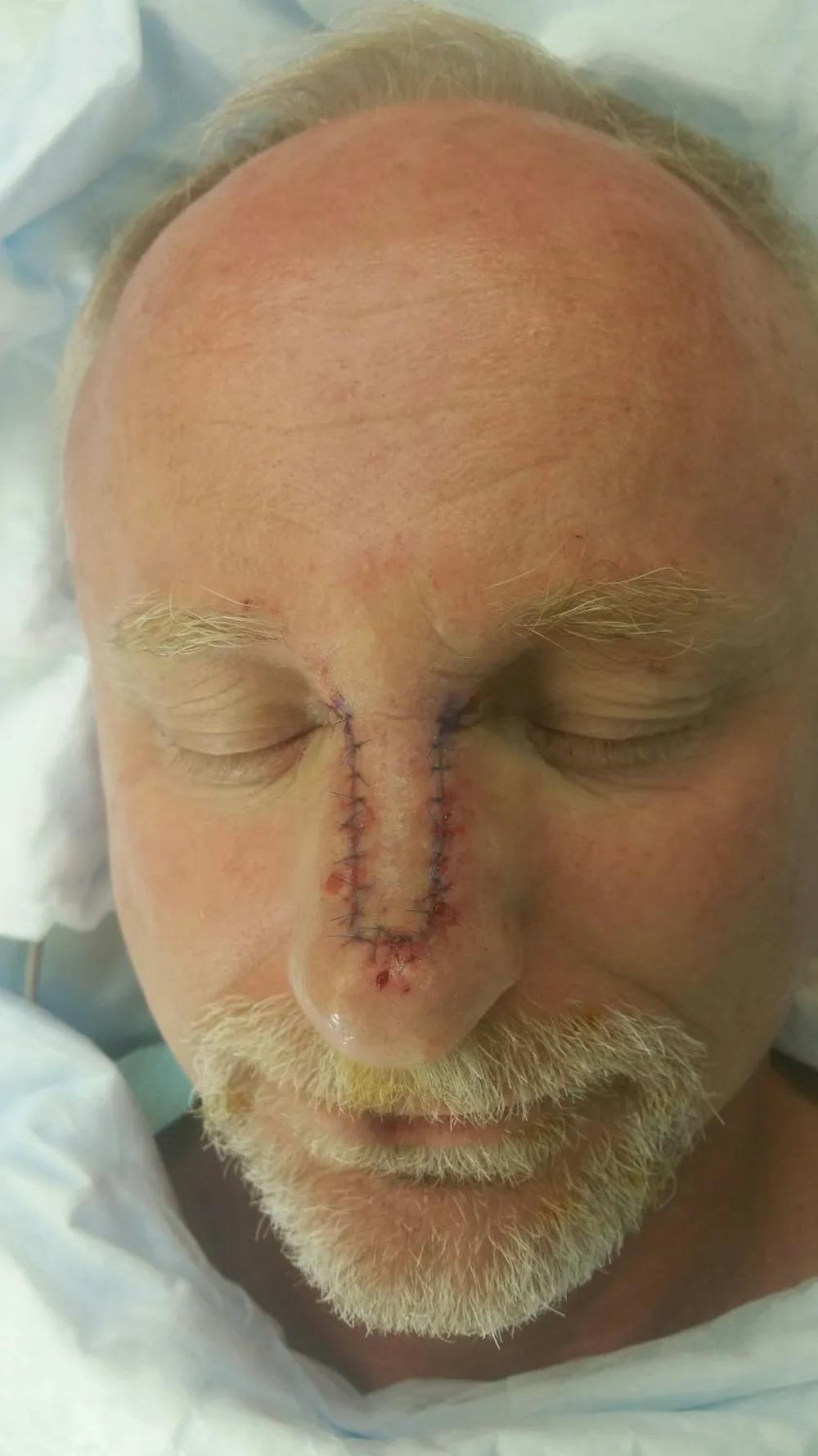 Facial and MOHS Reconstruction Before & After Gallery - Patient 5800805 - Image 2
