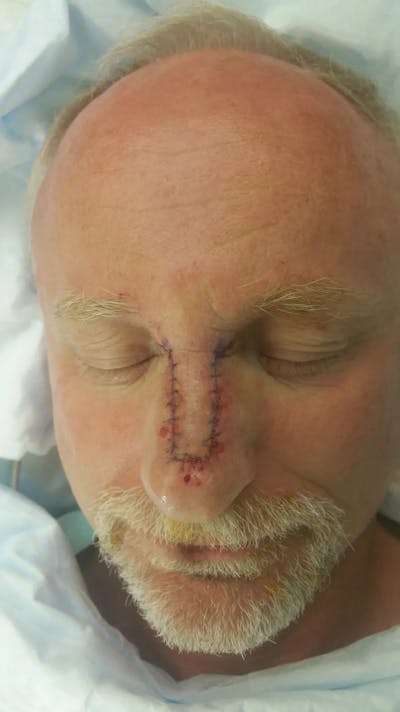 Facial and MOHS Reconstruction Before & After Gallery - Patient 5800805 - Image 2