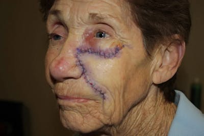 Facial and MOHS Reconstruction Before & After Gallery - Patient 5800806 - Image 2