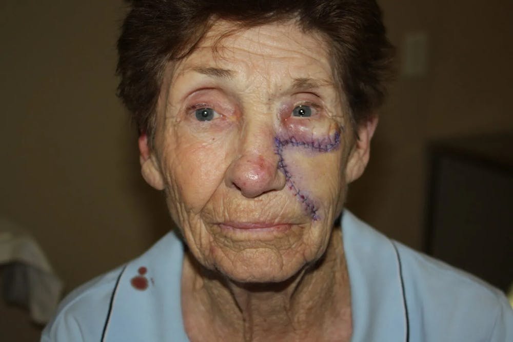 Facial and MOHS Reconstruction Before & After Gallery - Patient 5800806 - Image 3