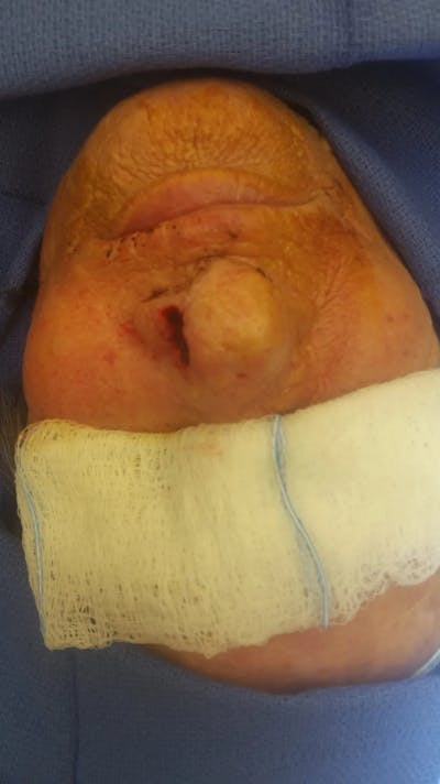 Facial and MOHS Reconstruction Before & After Gallery - Patient 5800807 - Image 2