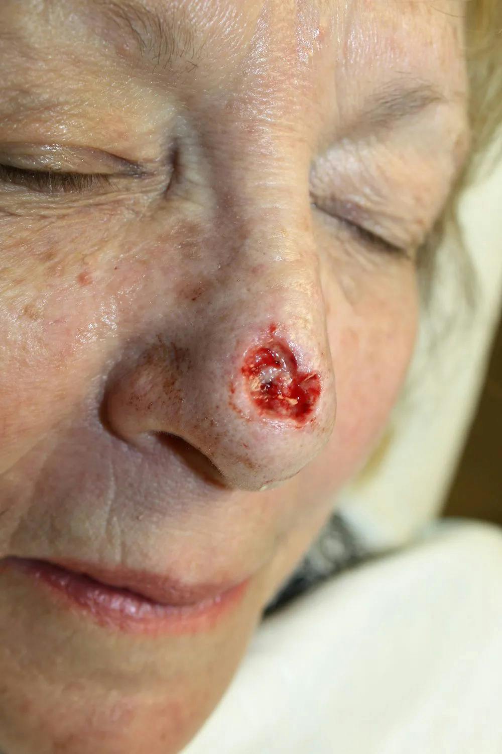 Facial and MOHS Reconstruction Before & After Gallery - Patient 5800808 - Image 2