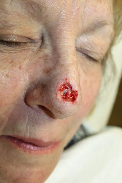 Facial and MOHS Reconstruction Before & After Gallery - Patient 5800808 - Image 2