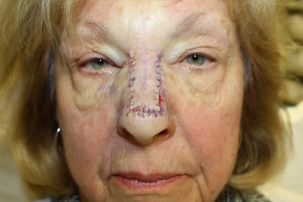 Facial and MOHS Reconstruction Before & After Gallery - Patient 5800808 - Image 3