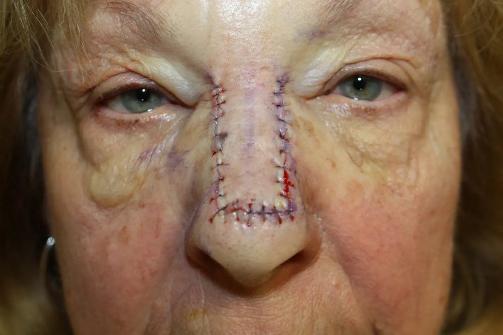 Facial and MOHS Reconstruction Before & After Gallery - Patient 5800808 - Image 4