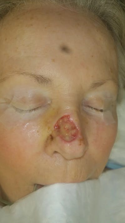 Facial and MOHS Reconstruction Before & After Gallery - Patient 5800809 - Image 1