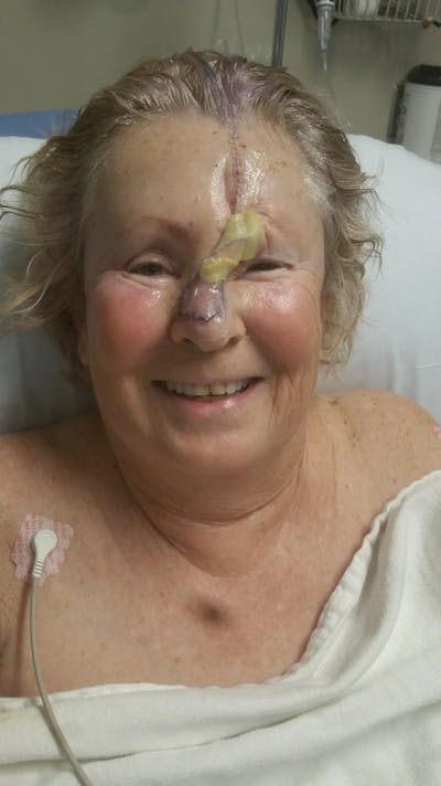 Facial and MOHS Reconstruction Before & After Gallery - Patient 5800809 - Image 2