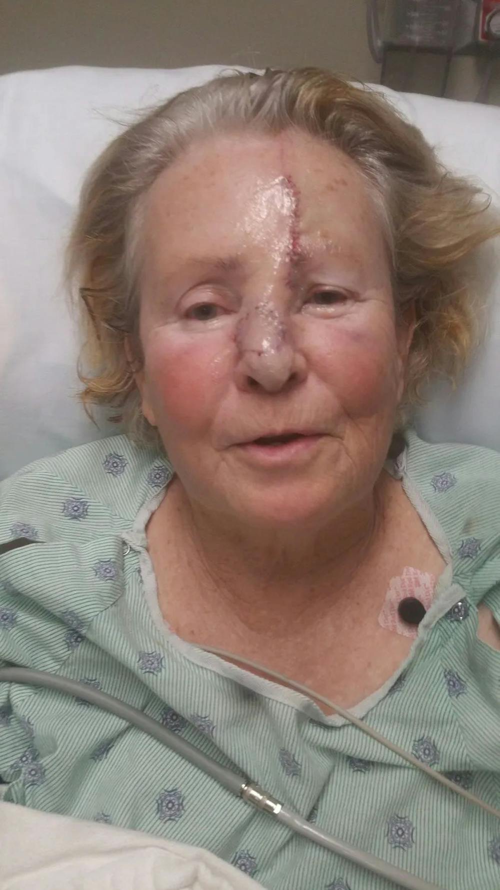 Facial and MOHS Reconstruction Before & After Gallery - Patient 5800809 - Image 3