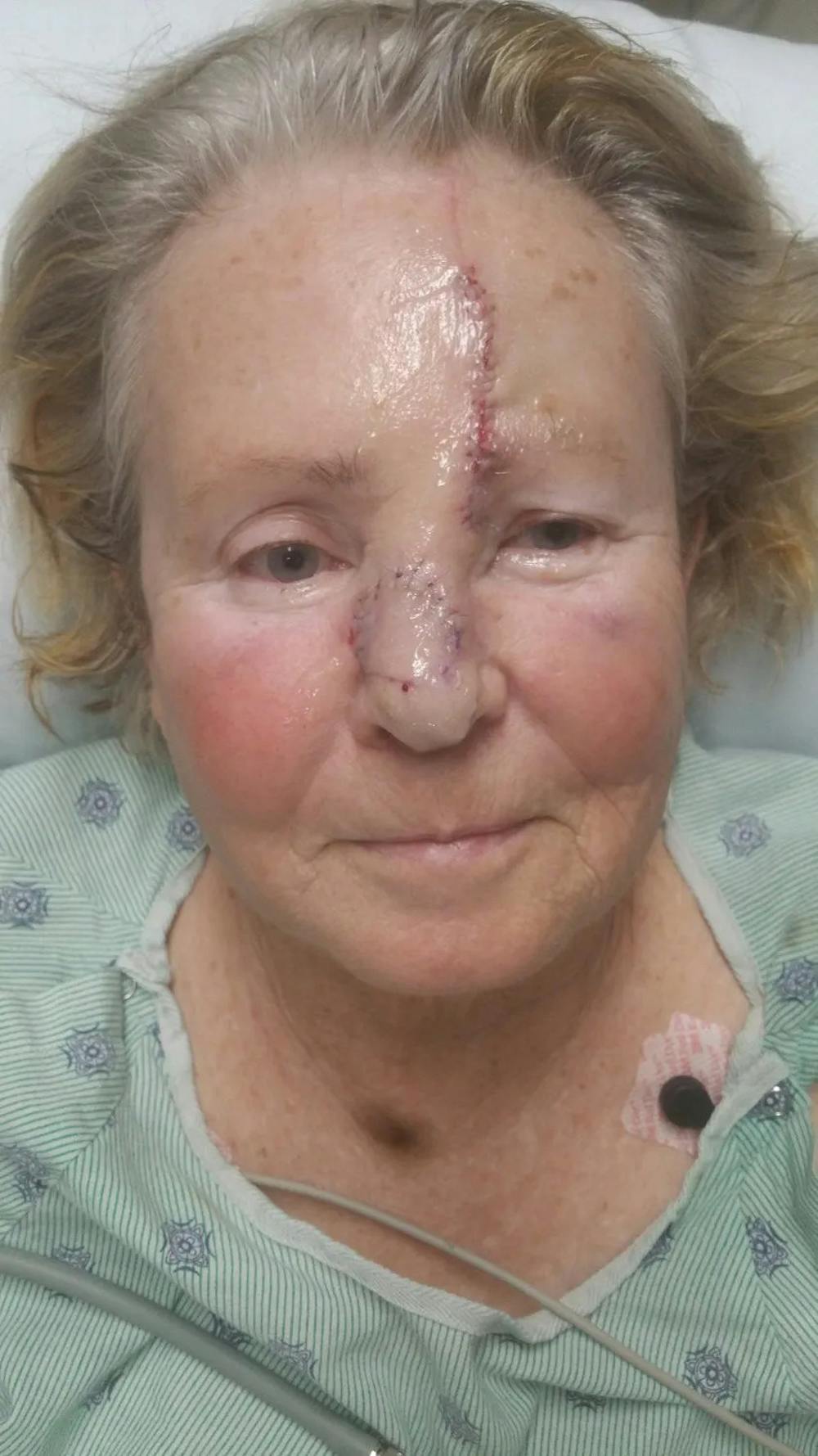 Facial and MOHS Reconstruction Before & After Gallery - Patient 5800809 - Image 4