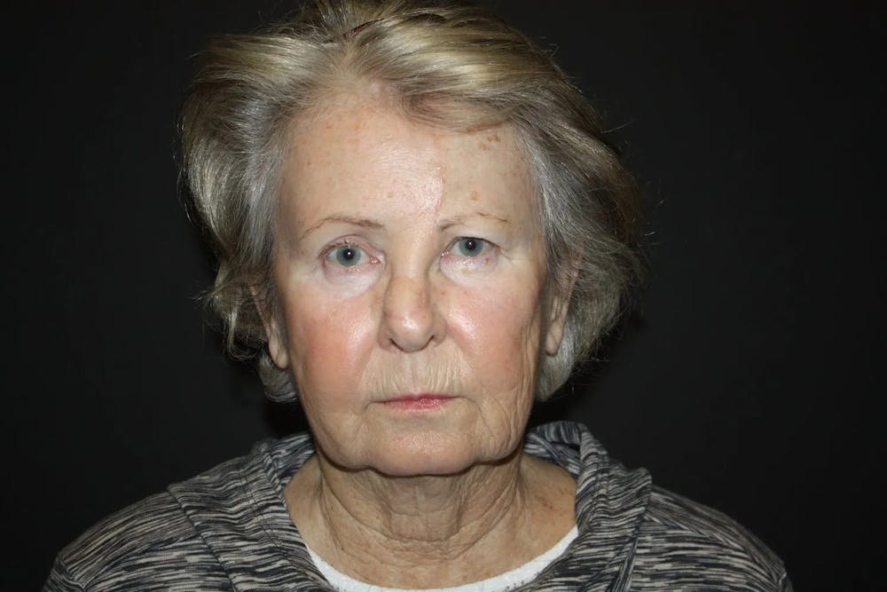 Facial and MOHS Reconstruction Before & After Gallery - Patient 5800809 - Image 5