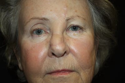 Facial and MOHS Reconstruction Before & After Gallery - Patient 5800809 - Image 6
