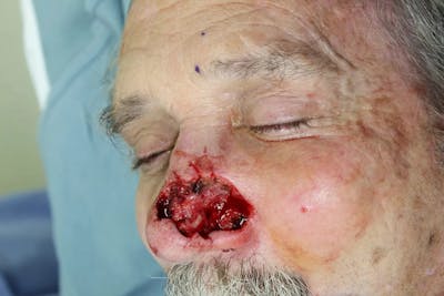 Facial and MOHS Reconstruction Before & After Gallery - Patient 5800810 - Image 1
