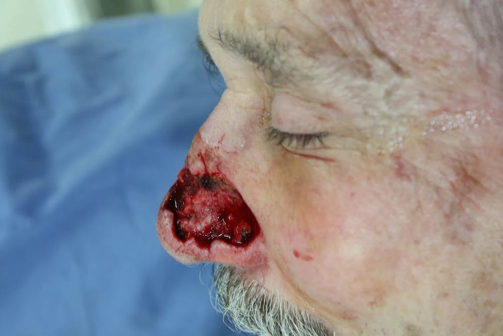 Facial and MOHS Reconstruction Before & After Gallery - Patient 5800810 - Image 2