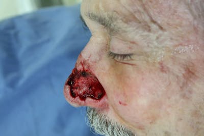 Facial and MOHS Reconstruction Before & After Gallery - Patient 5800810 - Image 2