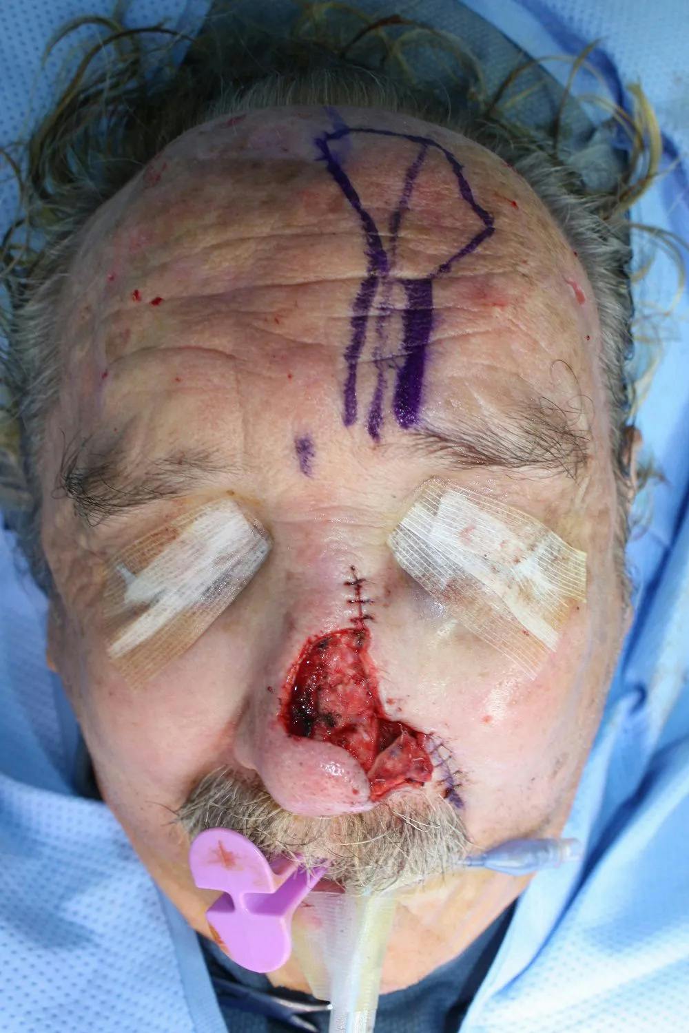 Facial and MOHS Reconstruction Before & After Gallery - Patient 5800810 - Image 3