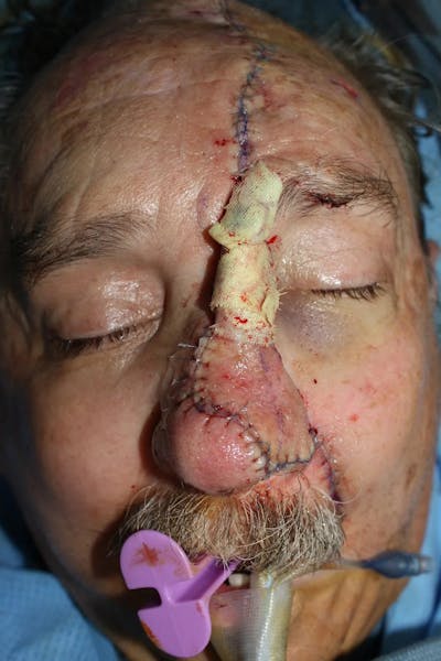 Facial and MOHS Reconstruction Before & After Gallery - Patient 5800810 - Image 4