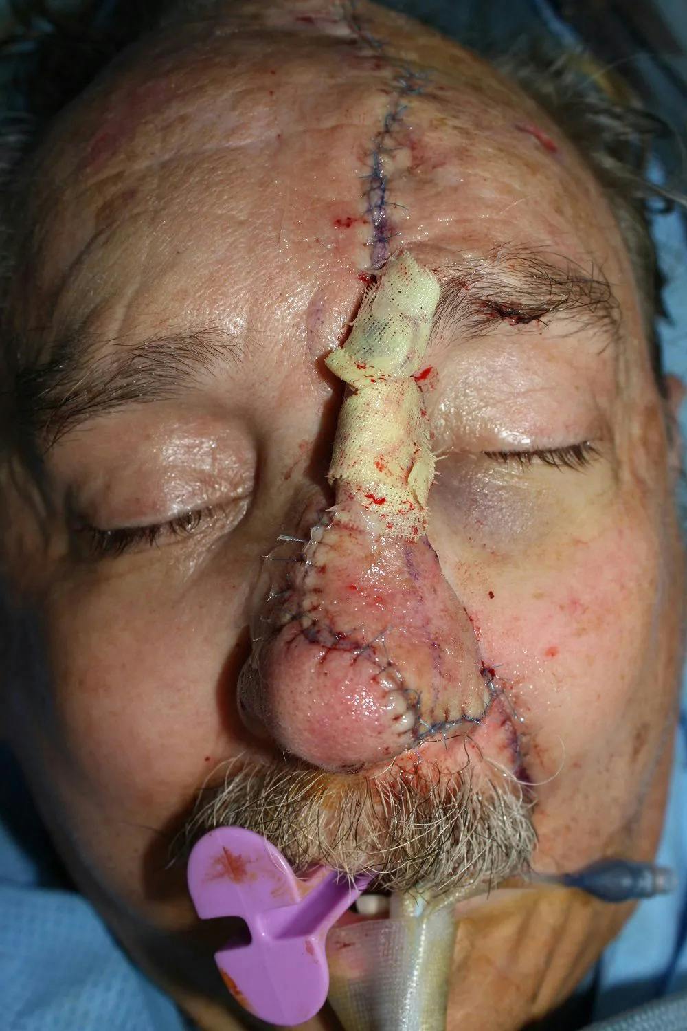 Facial and MOHS Reconstruction Before & After Gallery - Patient 5800810 - Image 4