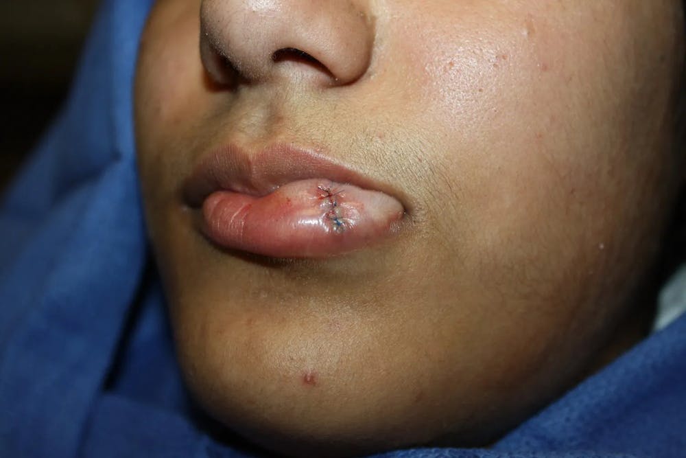 Facial and MOHS Reconstruction Before & After Gallery - Patient 5800811 - Image 3