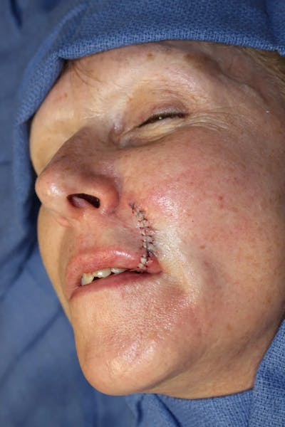 Facial and MOHS Reconstruction Before & After Gallery - Patient 5800812 - Image 2