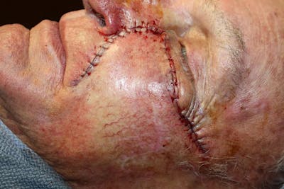 Facial and MOHS Reconstruction Before & After Gallery - Patient 5800813 - Image 2