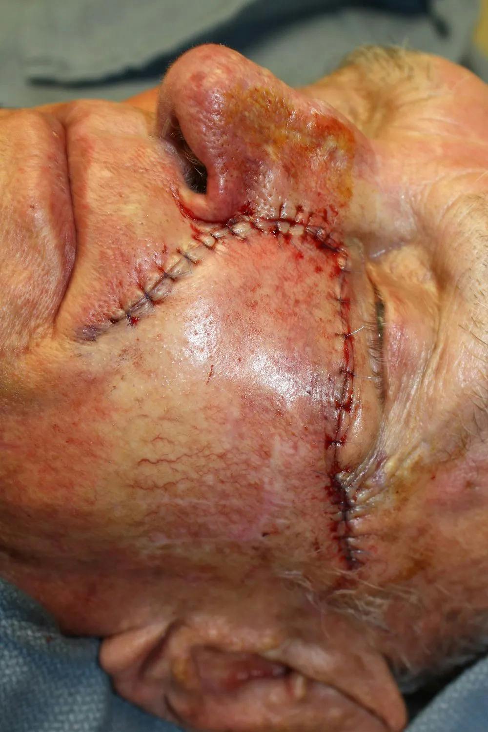 Facial and MOHS Reconstruction Before & After Gallery - Patient 5800813 - Image 3