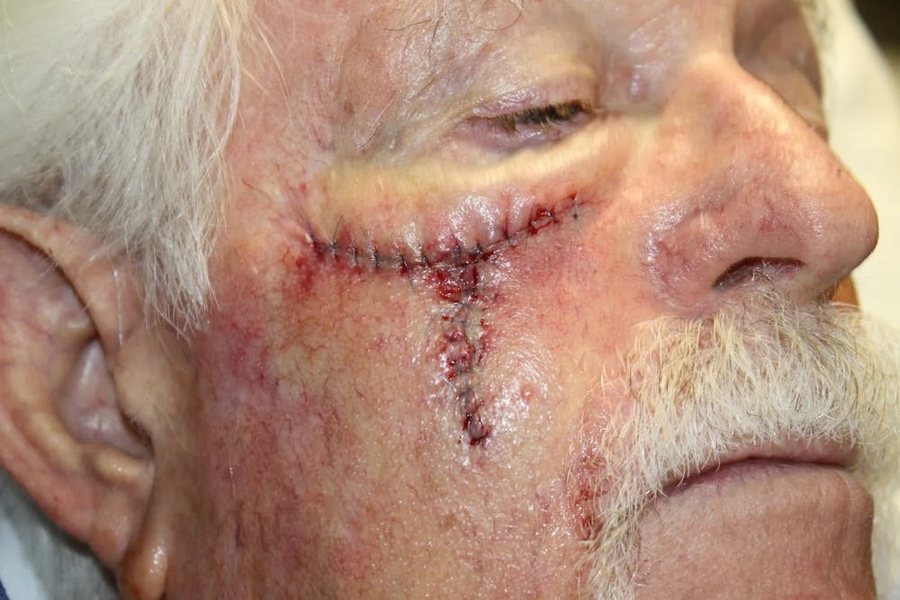 Facial and MOHS Reconstruction Before & After Gallery - Patient 5800814 - Image 2