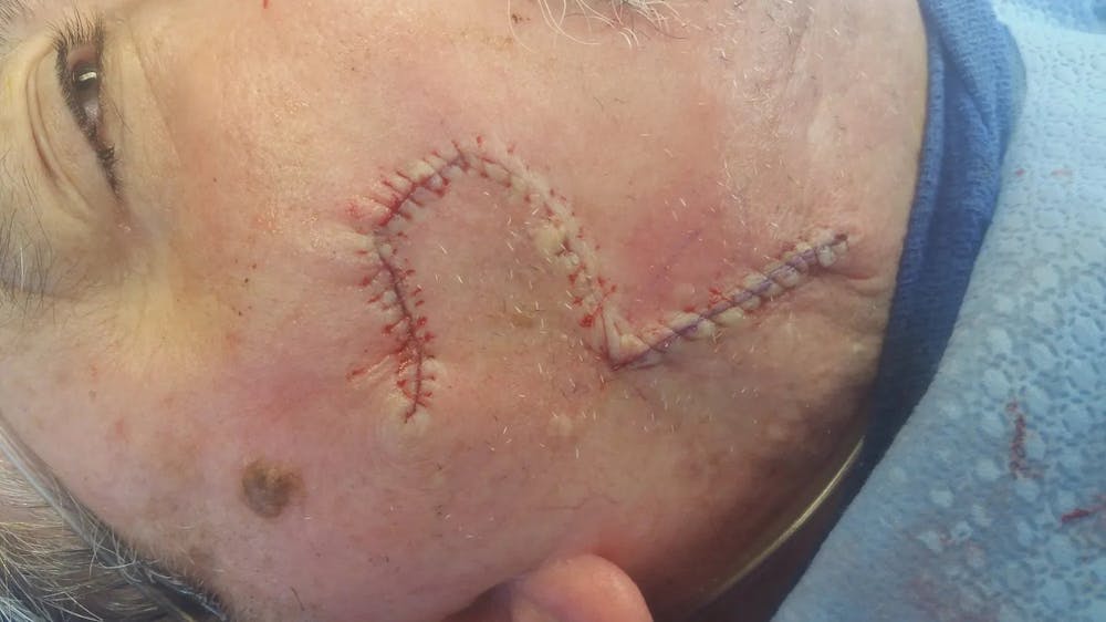 Facial and MOHS Reconstruction Before & After Gallery - Patient 5800815 - Image 2