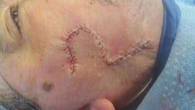 Facial and MOHS Reconstruction Before & After Gallery - Patient 5800815 - Image 2