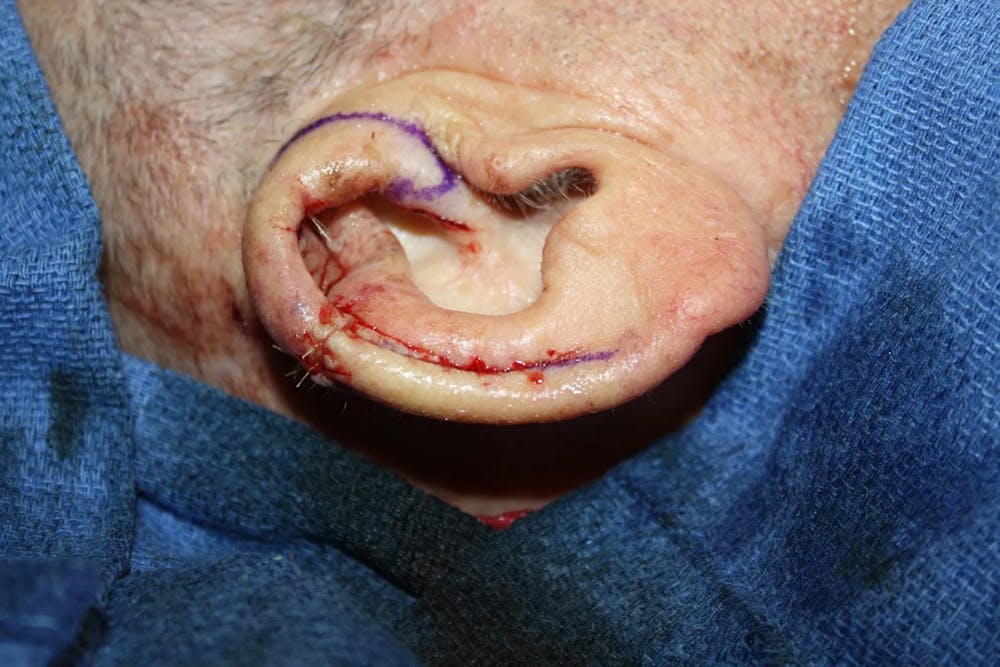 Facial and MOHS Reconstruction Before & After Gallery - Patient 5800816 - Image 2