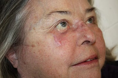 Facial and MOHS Reconstruction Before & After Gallery - Patient 5800817 - Image 1