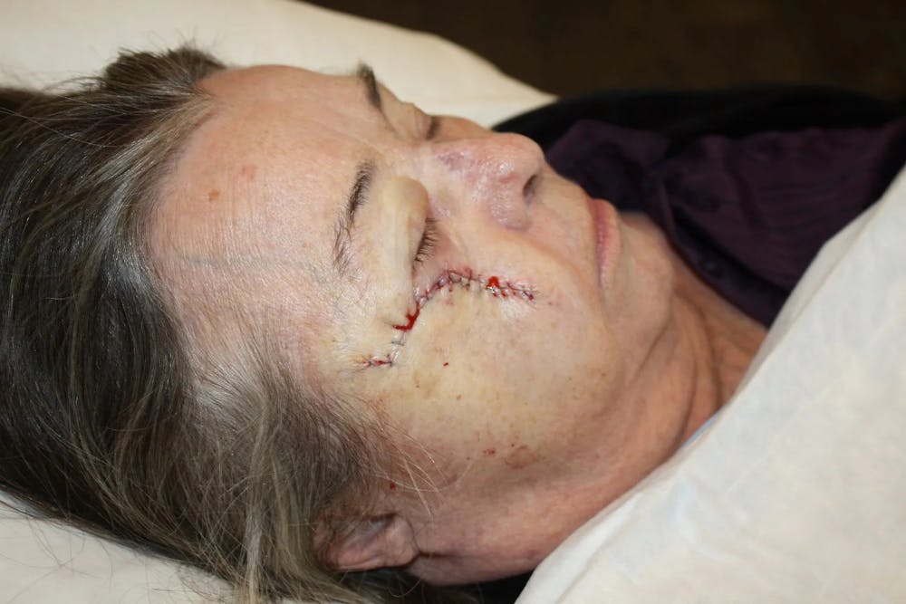 Facial and MOHS Reconstruction Before & After Gallery - Patient 5800817 - Image 2