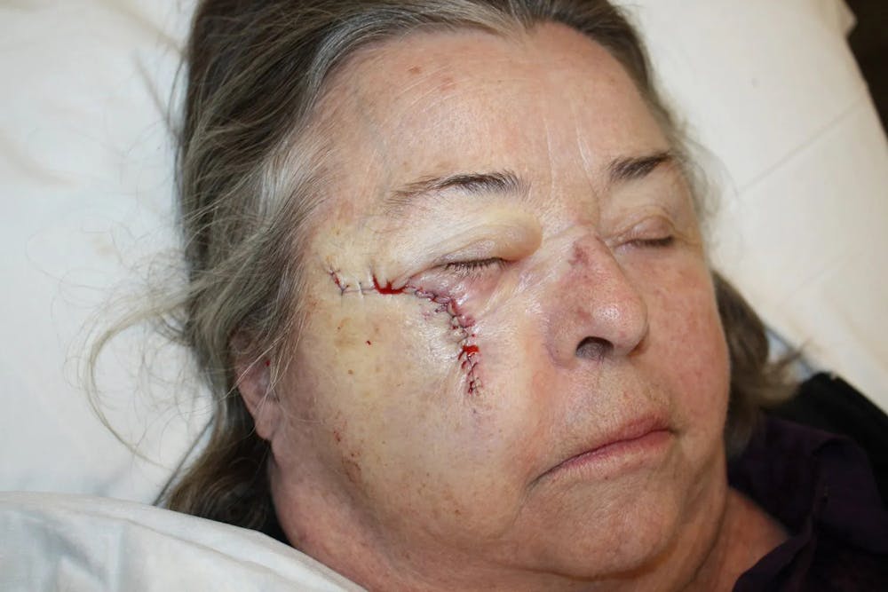 Facial and MOHS Reconstruction Before & After Gallery - Patient 5800817 - Image 3