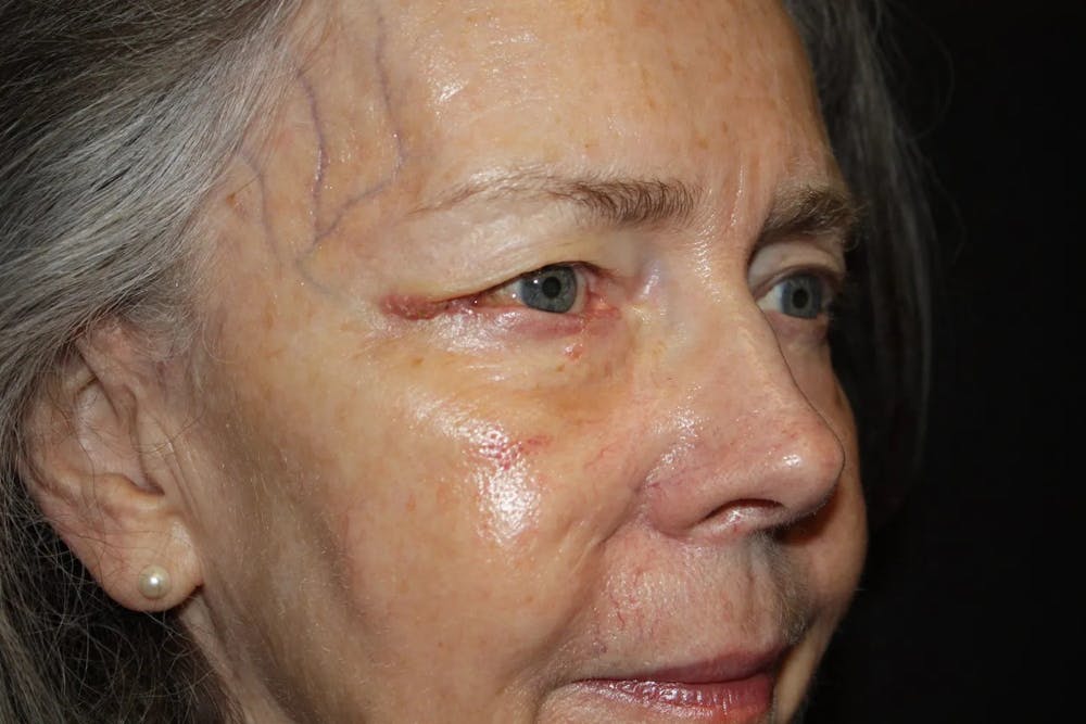Facial and MOHS Reconstruction Before & After Gallery - Patient 5800821 - Image 1
