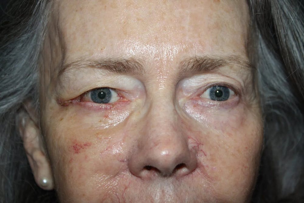 Facial and MOHS Reconstruction Before & After Gallery - Patient 5800821 - Image 2