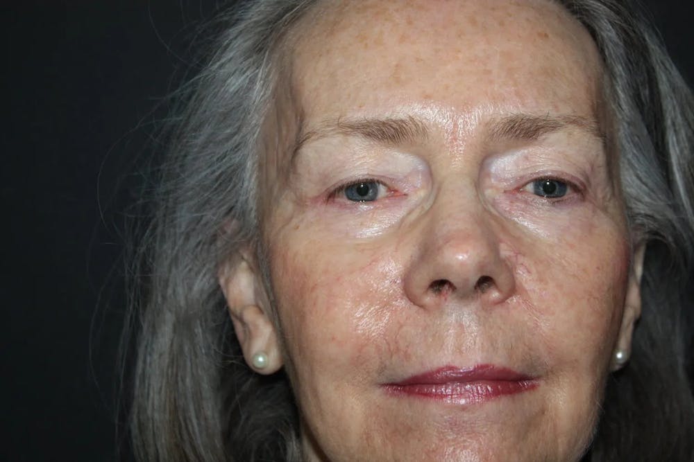 Facial and MOHS Reconstruction Before & After Gallery - Patient 5800821 - Image 3