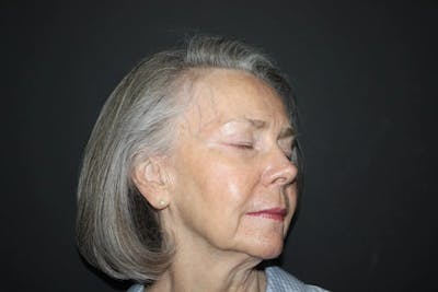 Facial and MOHS Reconstruction Before & After Gallery - Patient 5800821 - Image 4