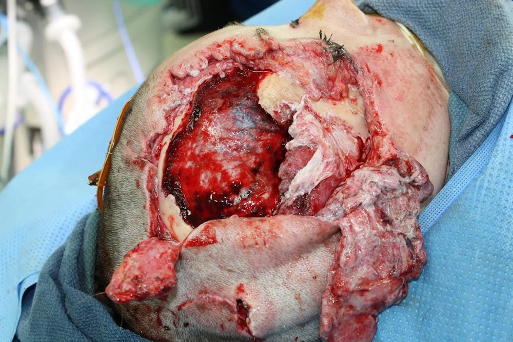 Facial and MOHS Reconstruction Before & After Gallery - Patient 5800822 - Image 4