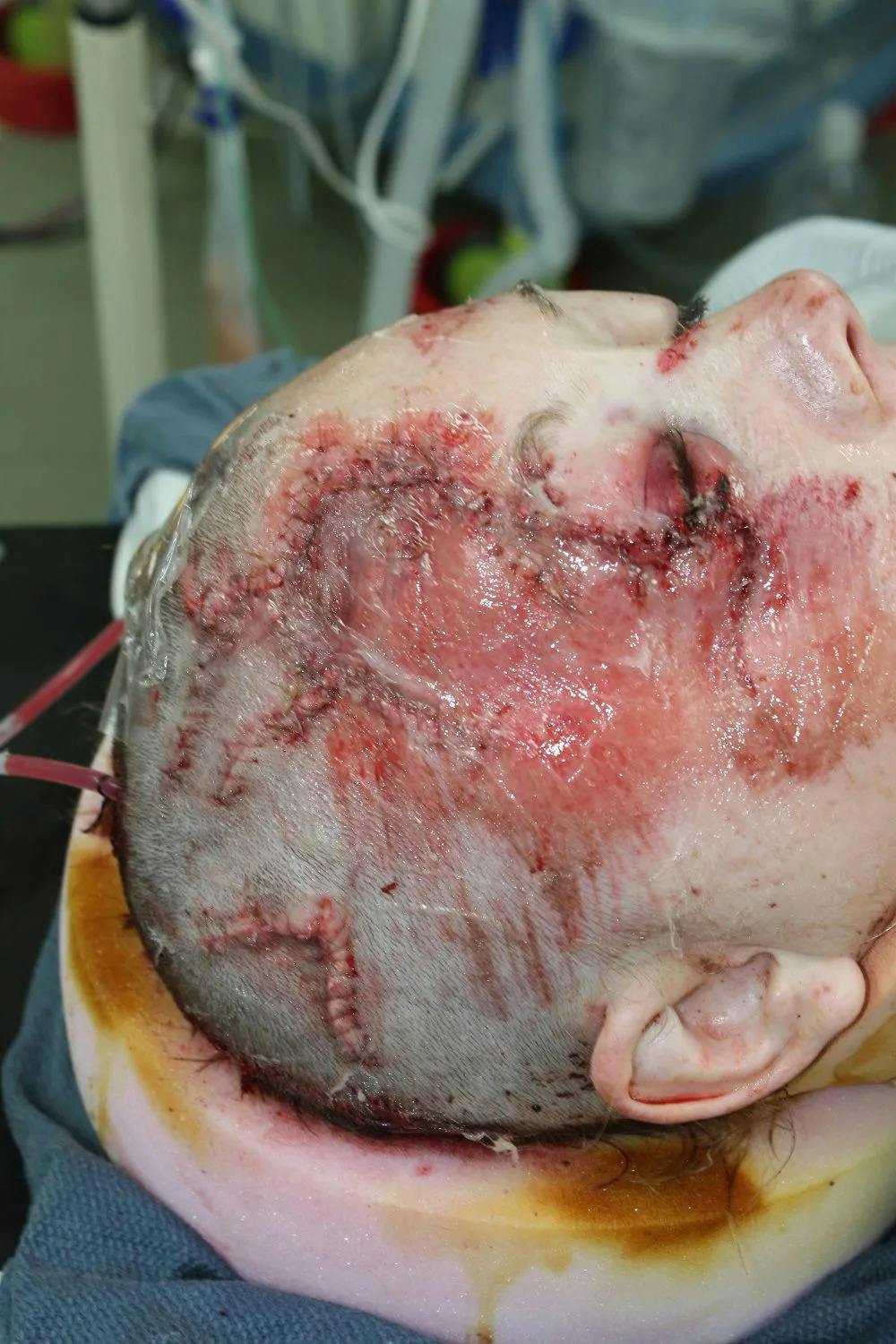 Facial and MOHS Reconstruction Before & After Gallery - Patient 5800822 - Image 5