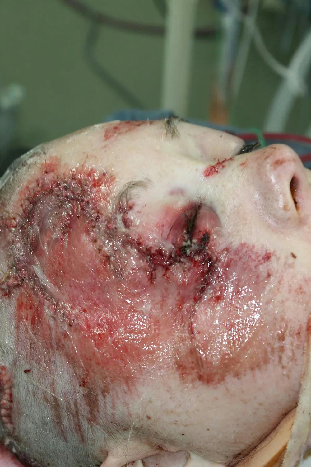 Facial and MOHS Reconstruction Before & After Gallery - Patient 5800822 - Image 6