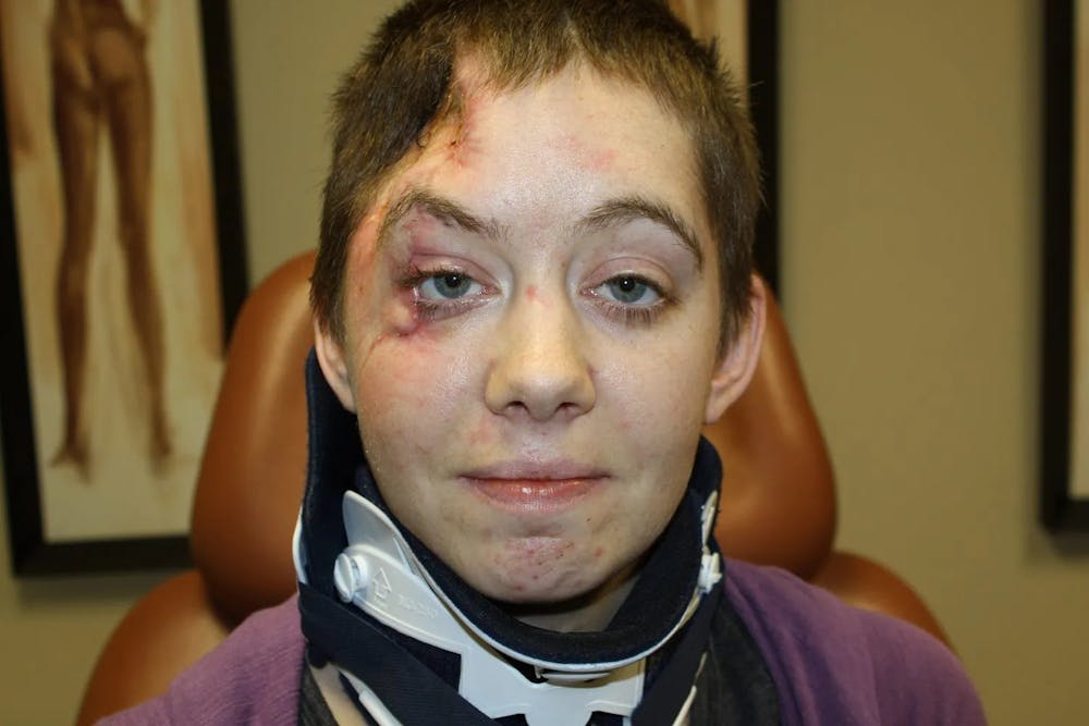 Facial and MOHS Reconstruction Before & After Gallery - Patient 5800822 - Image 7