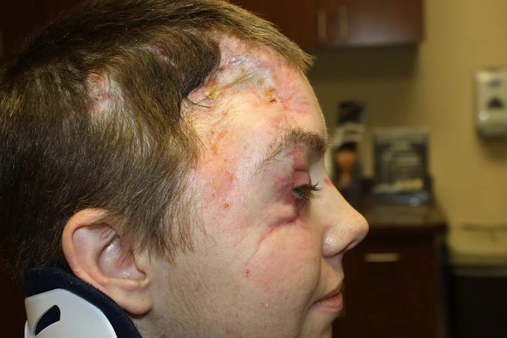 Facial and MOHS Reconstruction Before & After Gallery - Patient 5800822 - Image 9