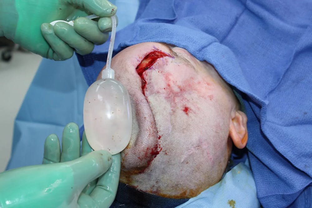 Facial and MOHS Reconstruction Before & After Gallery - Patient 5800822 - Image 10