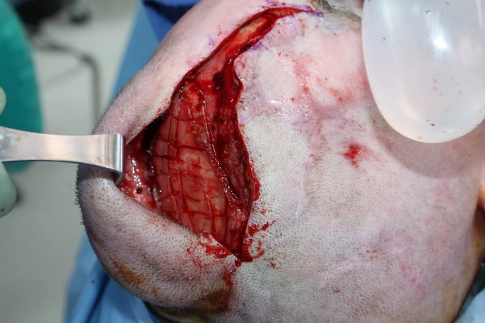 Facial and MOHS Reconstruction Before & After Gallery - Patient 5800822 - Image 11
