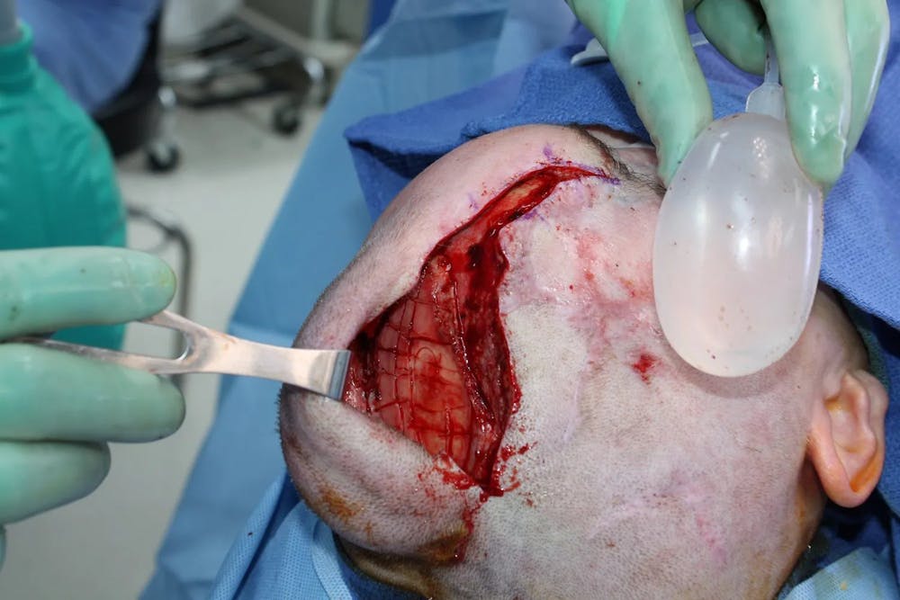 Facial and MOHS Reconstruction Before & After Gallery - Patient 5800822 - Image 12